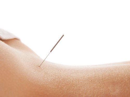 Reasons Why Acupuncture Works