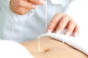 Acupuncture